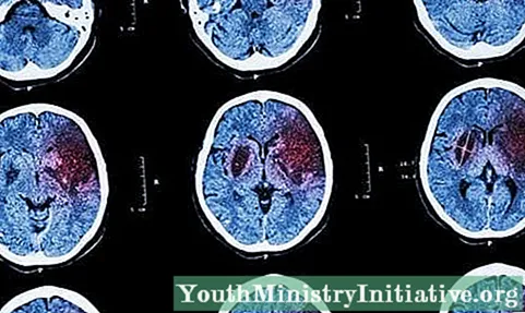 脳卒中：定義、原因、症状および治療